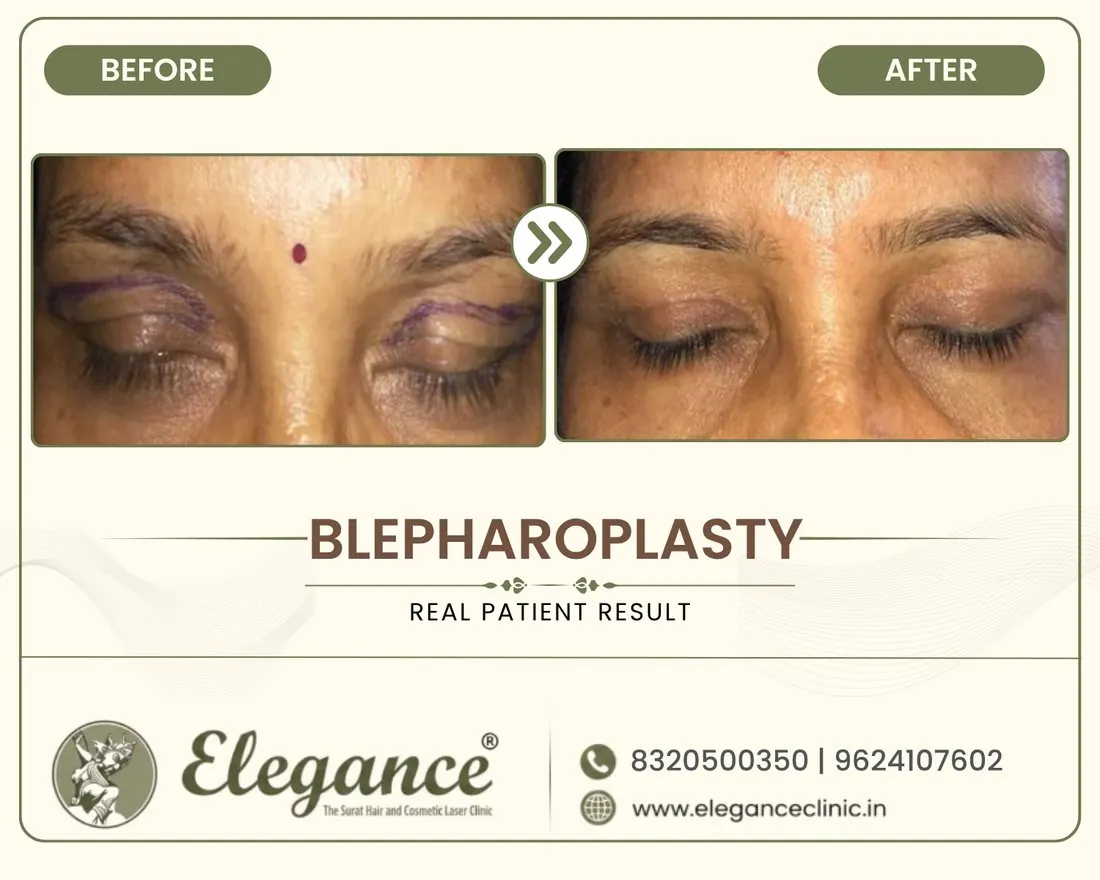 Blepharoplasty before and after result