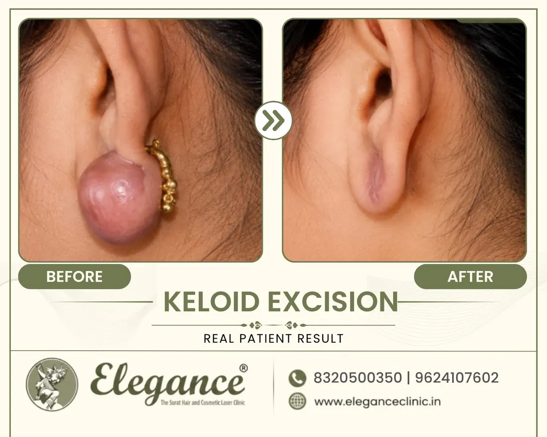 Keloid Excision before and after result
