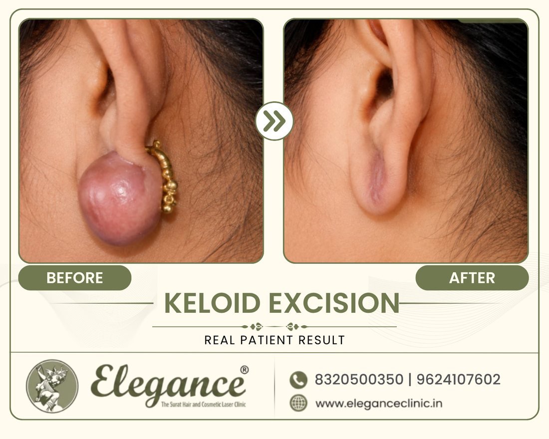 Keloid Excision 2 result