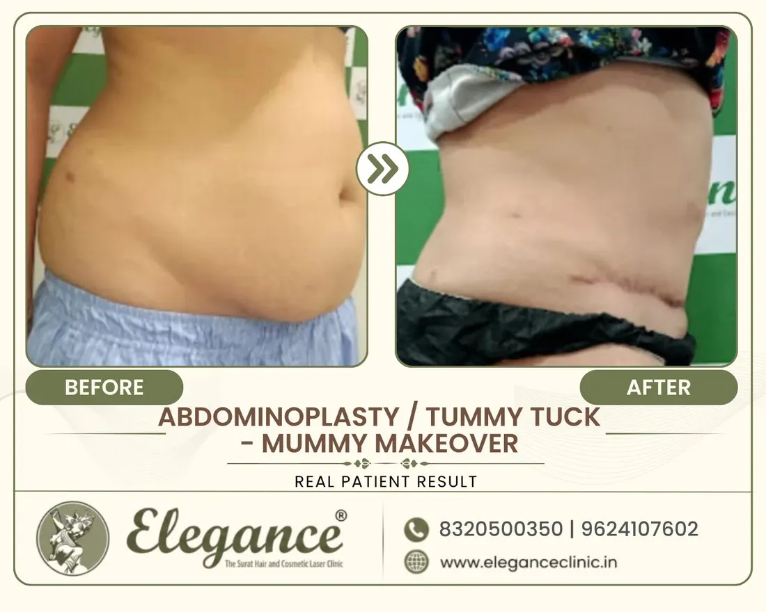 Tummy Tuck Mummy Makeover before and after result